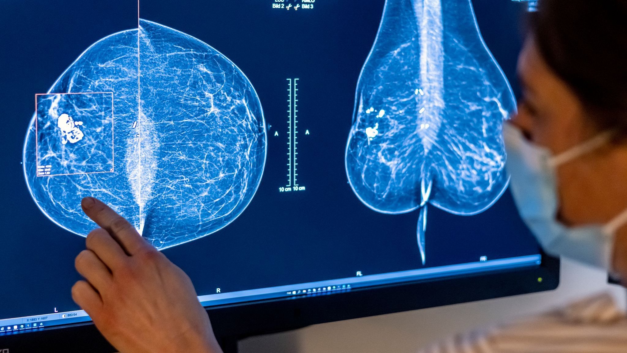 Metastatic breast cancer: “Like a doctor in a handbag” – App for breast cancer patients