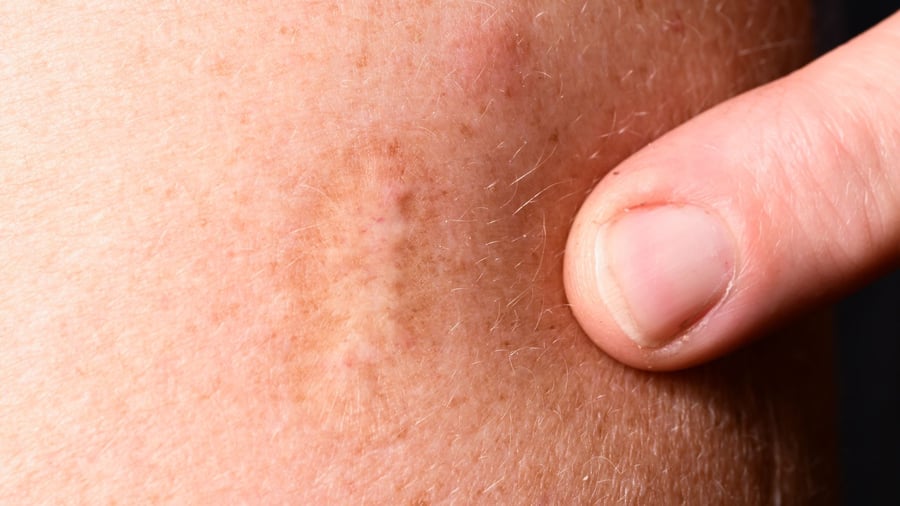 Genetic proof: Europeans brought smallpox to America