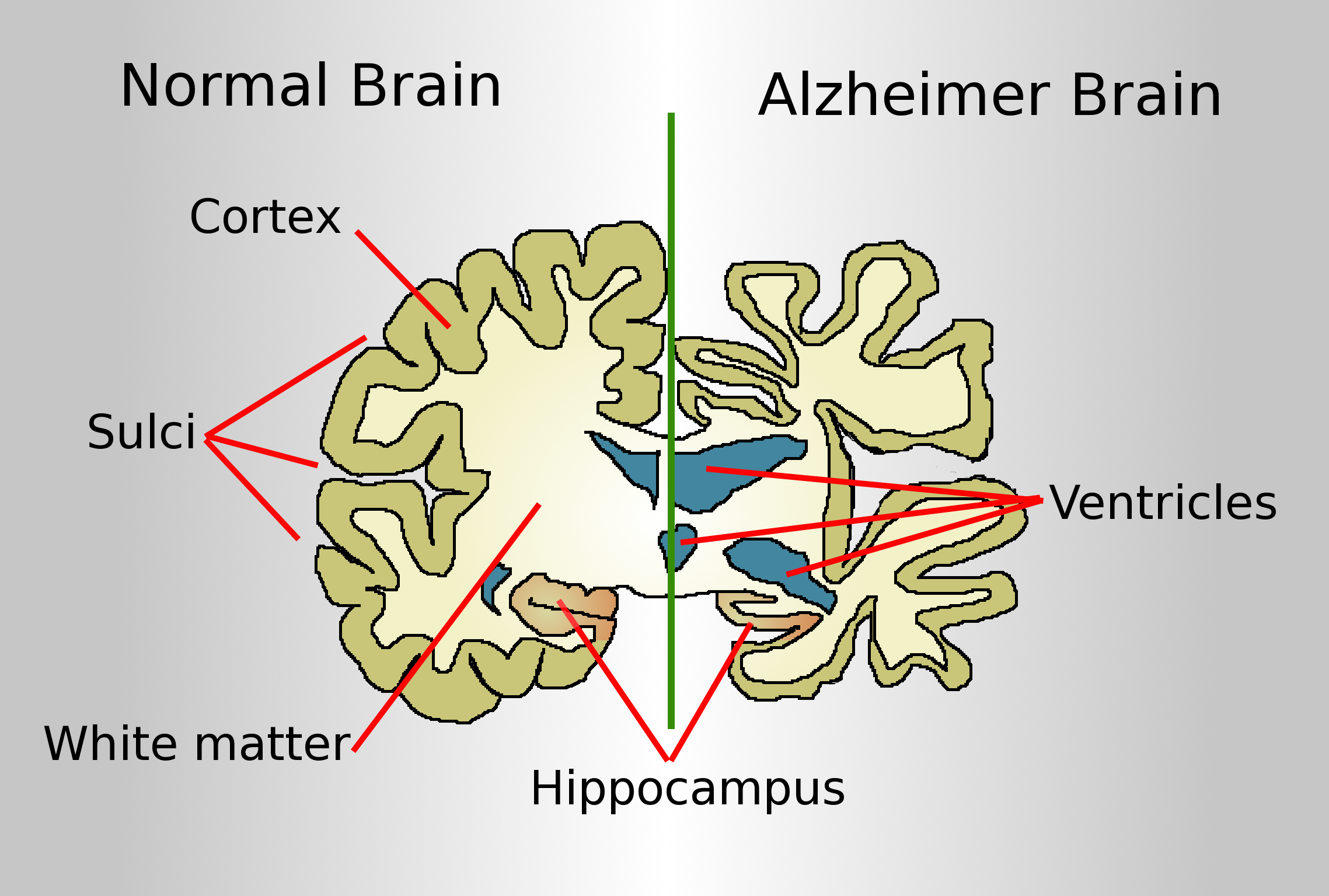 Alzheimer, from the Vatican the appeal not to leave only patients and caregiver
