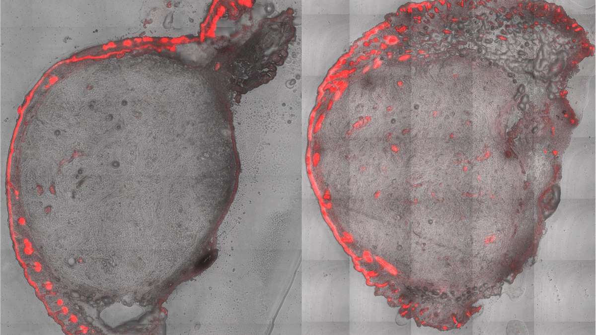 Skin cancer treatment with microneedles solves two problems