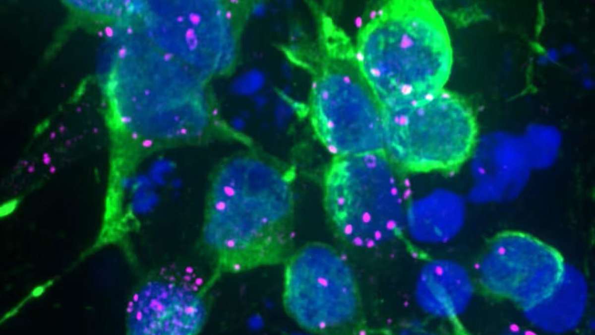 Parkinson’s protein blocks cell cleansing – and could damage nerve cells early